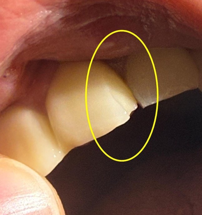 유명 프랜차이즈 햄버거 패티에서 금속조각이 나와 소비자의 앞니가 깨지는 사고가 발생했다. 출처=보배드림