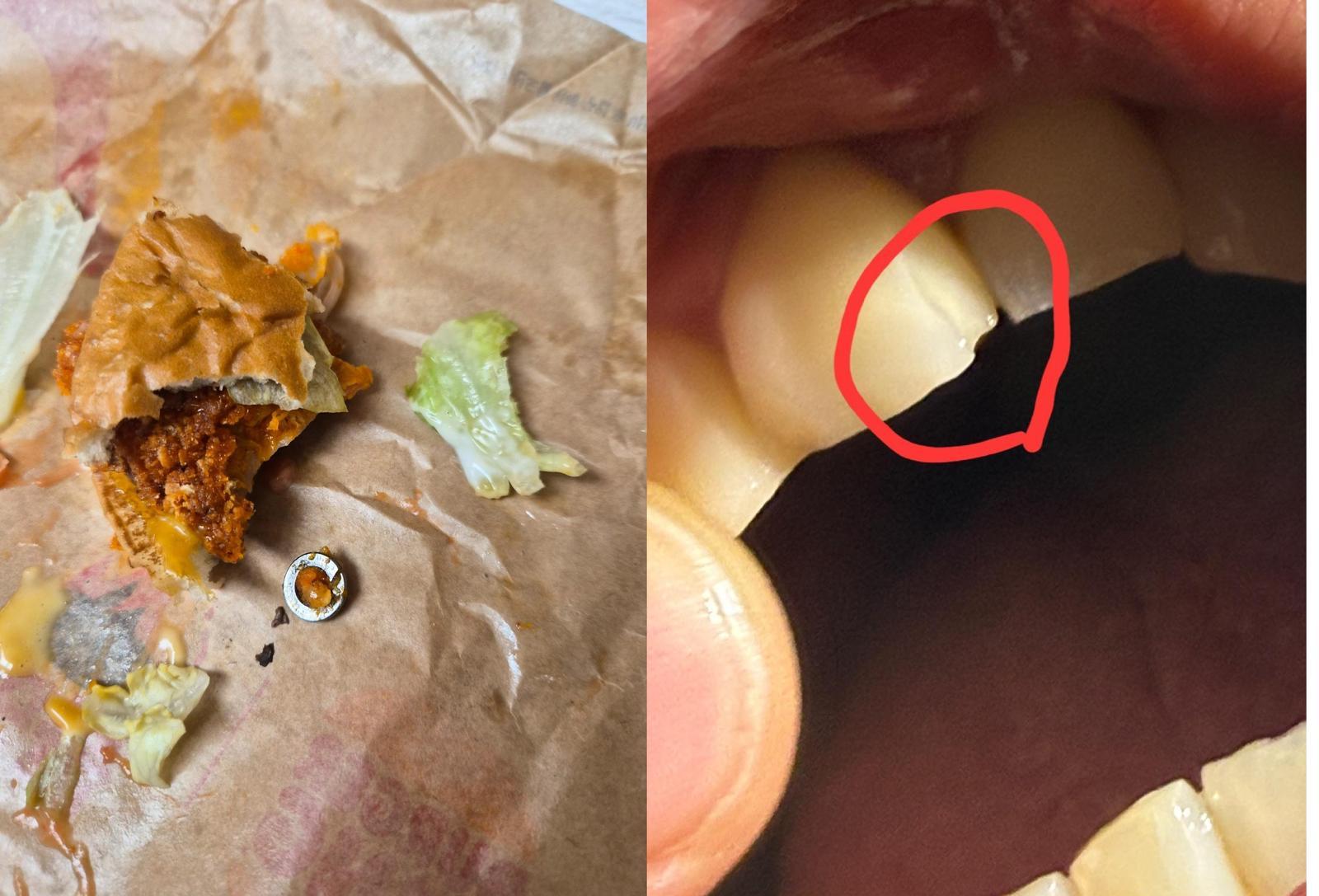 햄버거를 먹다가 볼트를 깨물어 이빨이 부서졌다는 사연자. 온라인 커뮤니티 보배드림 캡처