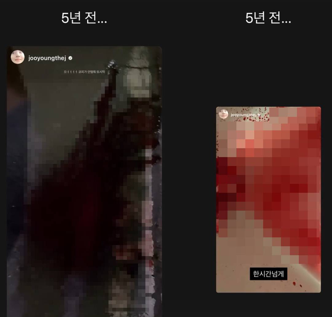 배우 차주영(왼쪽)이 5년 전 심각했던 비출혈 모습을 공개했다. 인스타그램