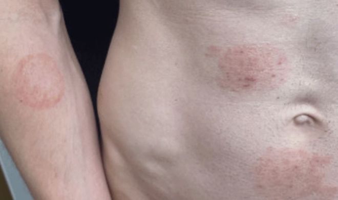 미국 질병통제예방센터(CDC)