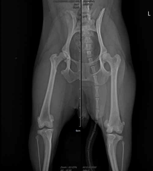 올바른 예시: 허벅지뼈가 정면을 정확히 응시하도록 촬영되어, 뼈의 변형 정도와 수술 위치를 정밀하게 파악