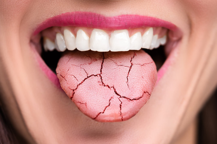 구강 건조증은 인구 20%가 겪는 흔한 증상이지만, 약물 부작용이나 수면 무호흡증 등 다양한 질환과 연계되어 수면의 질을 저해한다. 사진=게티이미지뱅크.