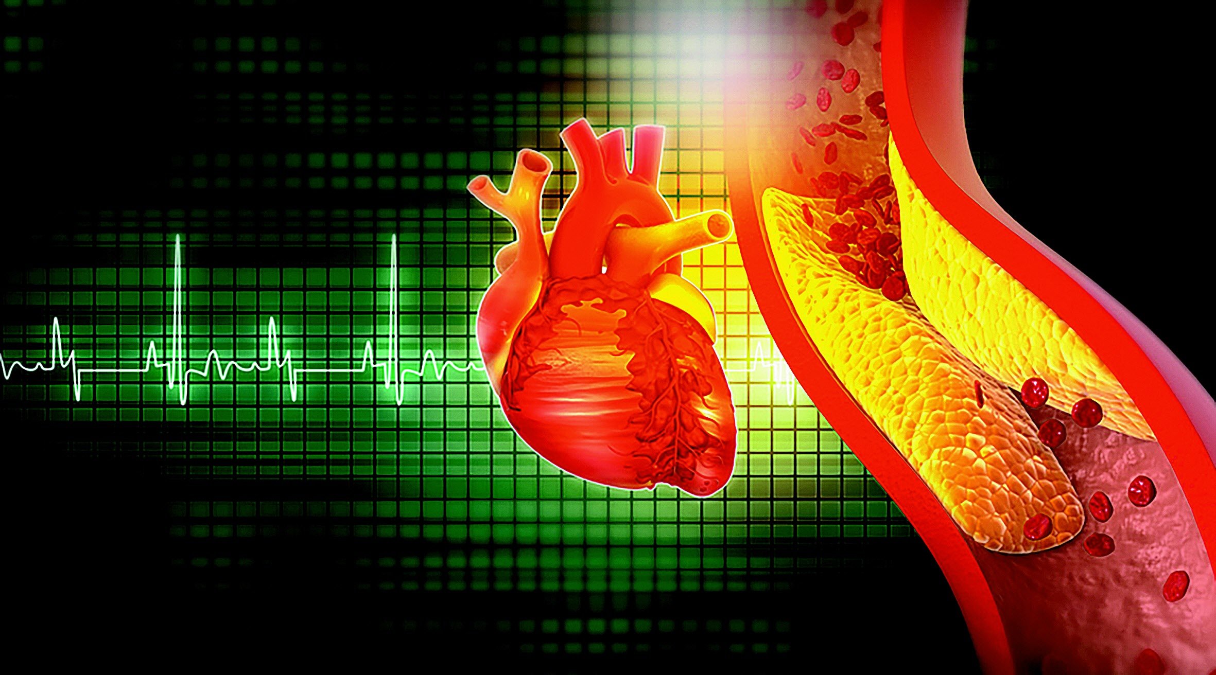 고지혈증을 나타낸 그림. 혈관 벽에 계속 지방이 쌓이면 동맥이 점차 좁아지고 딱딱해지는 죽상동맥경화증으로 이어질 수 있다. 게티이미지뱅크