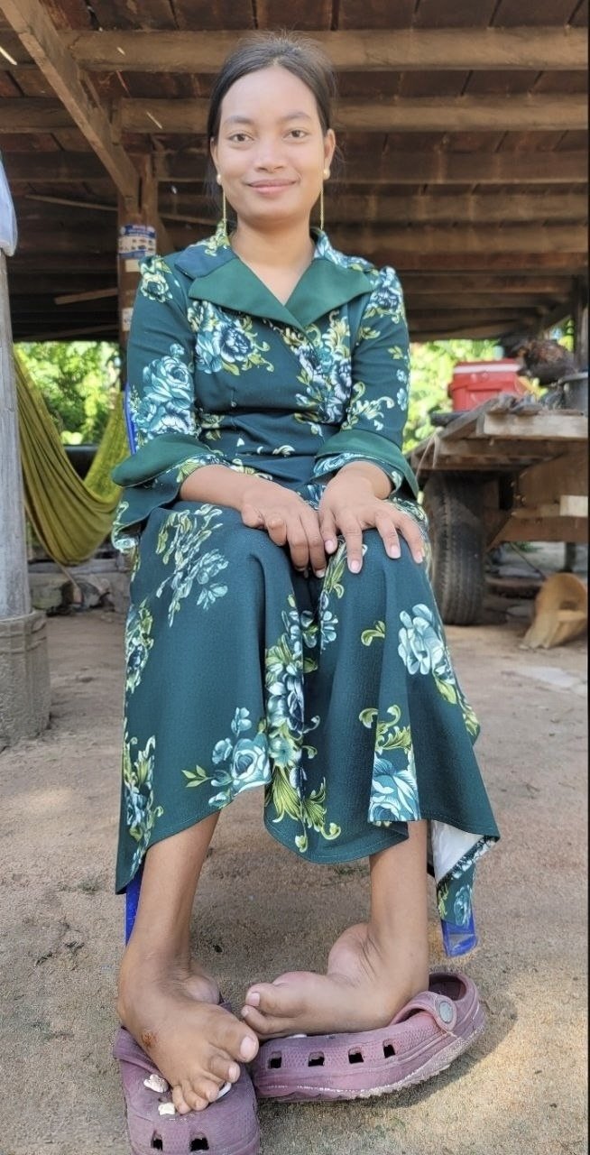 수술 전 심한 선천성 만곡족을 앓고 있던 떼움 쿤떼아의 모습. 사진=순천향대 부천병원 제공