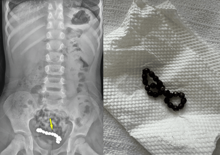 1년간 복통을 호소해 온 4세 남아의 뱃속에서 자석 조각 22개가 발견됐다. 큐레우스 캡처