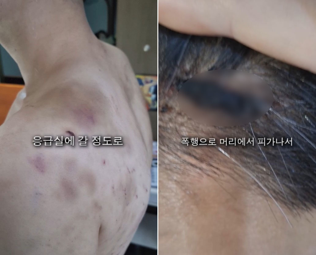 부산의 한 중국집 사장이 직원을 수년간 감금·폭행했다는 주장이 제기됐다. 피해자의 상체에 피멍이 들고 머리에서 피가 난 모습. 스레드 캡처