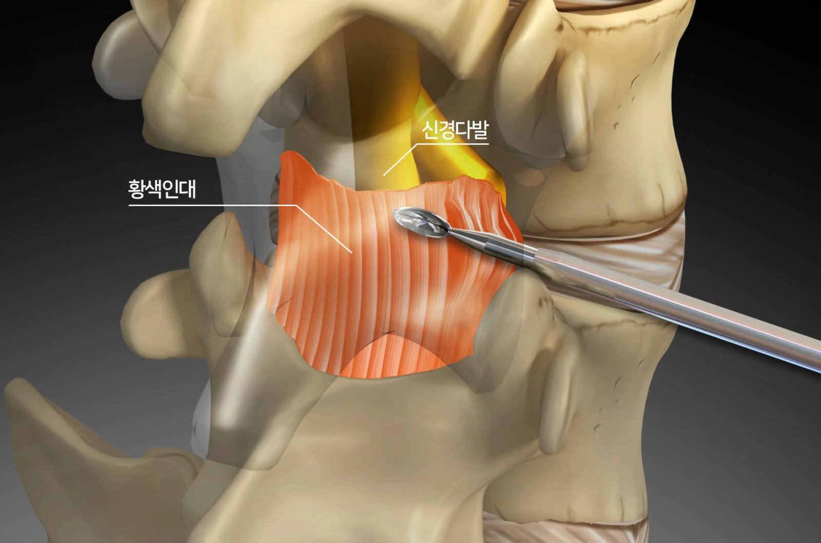 추간공 접근법을 이용해 특수 키트로 척추관 후방부의 황색 인대를 절제하는 모습. 서울 광혜병원 제공
