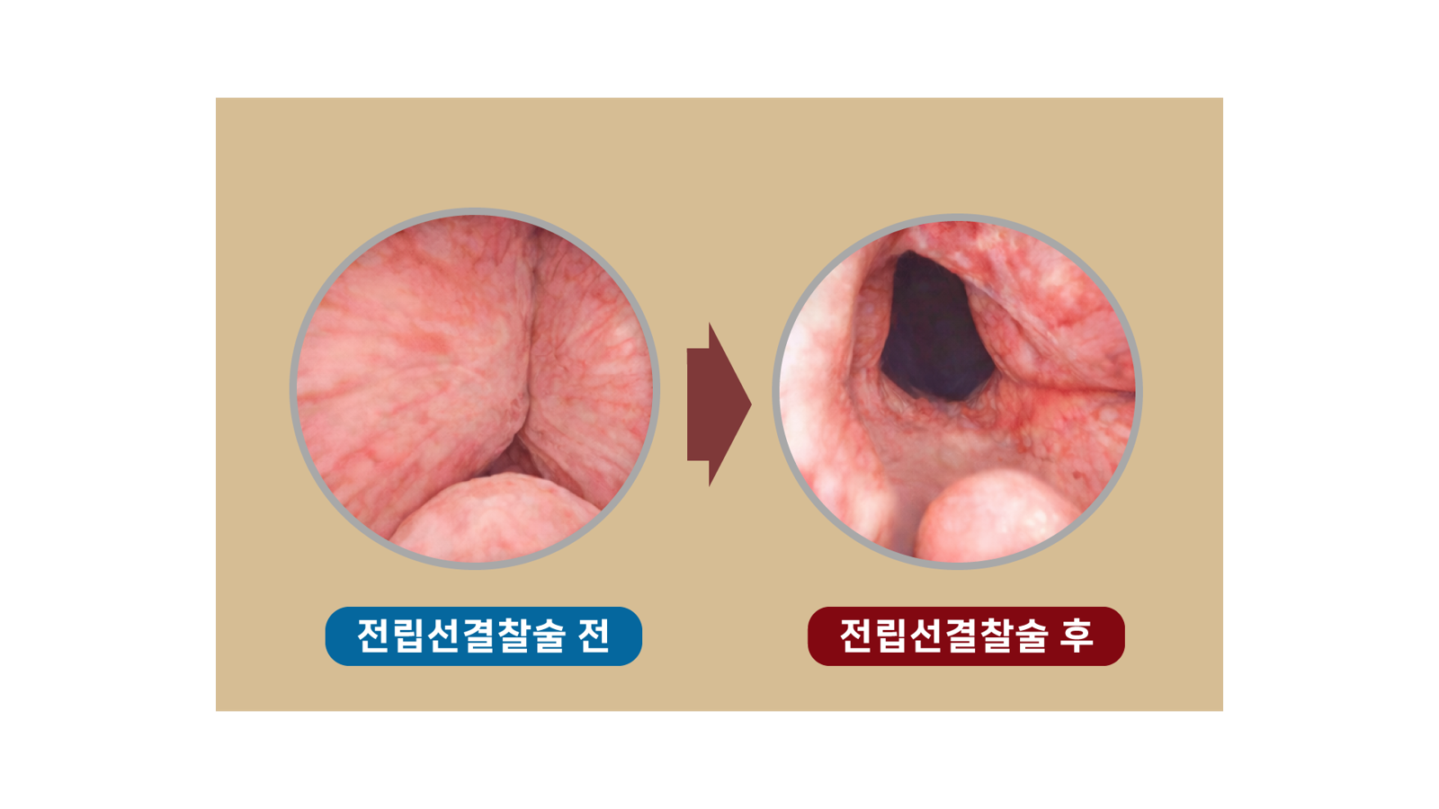 전립선결찰술 시술 전과 후 - 시술 전, 시술 후