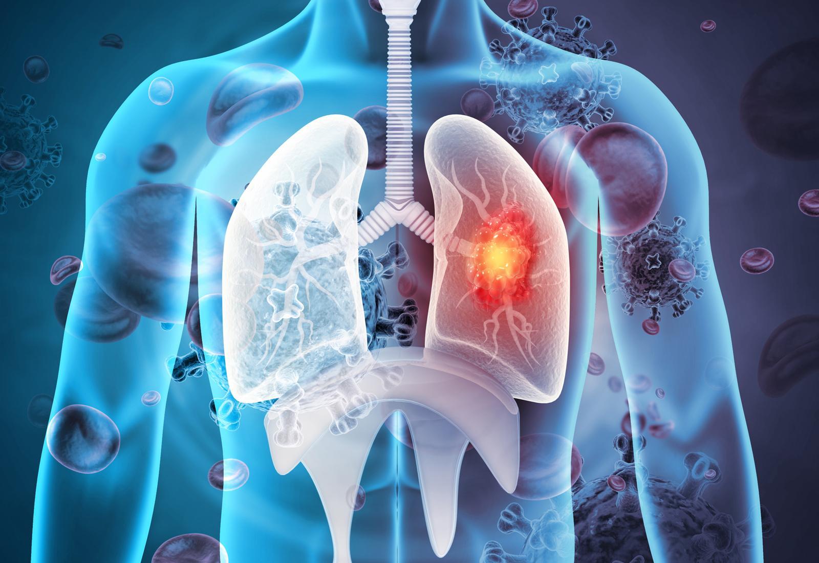 최근 치료 환경이 빠르게 변하면서 폐암은 ‘장기적으로 관리 가능한 질환’으로 인식이 바뀌고 있다.
게티이미지뱅크