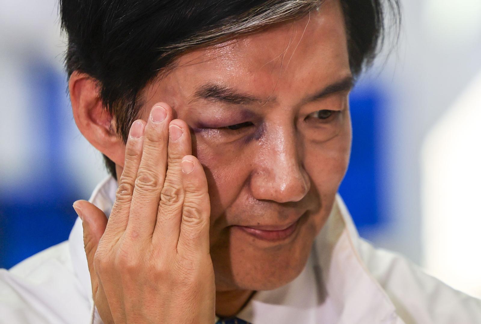 오른쪽 눈 붓고 멍든 채 후보자 등록한 조국…무슨 일?