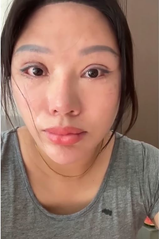“눈을 감을 수가 없다”…쌍꺼풀 수술 후유증 겪은 中 여성