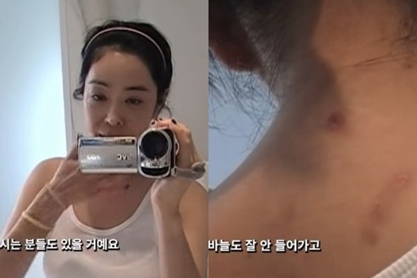 이혜영, 폐암 투병 5년…“흉터 많이 남아, 속상하지만 이겨낼 것”