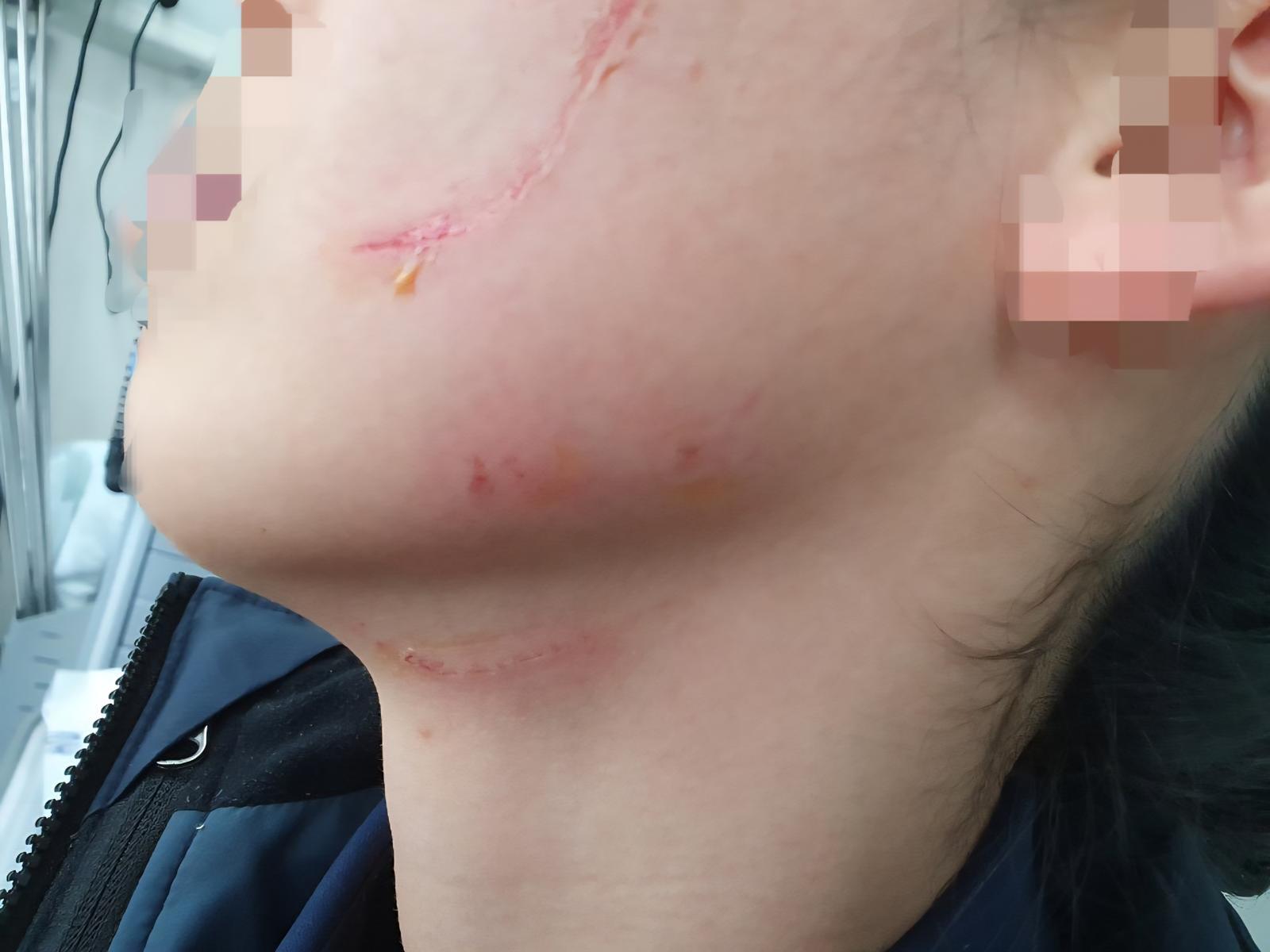 청주여자교도소에서 한 교도관이 수용자에게 폭행당해 얼굴에 상처가 난 모습. 법무부 제공