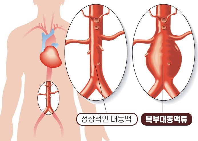 배에서 ‘쿵쿵’ 박동소리…혹시 ‘이 질환’ 신호?
