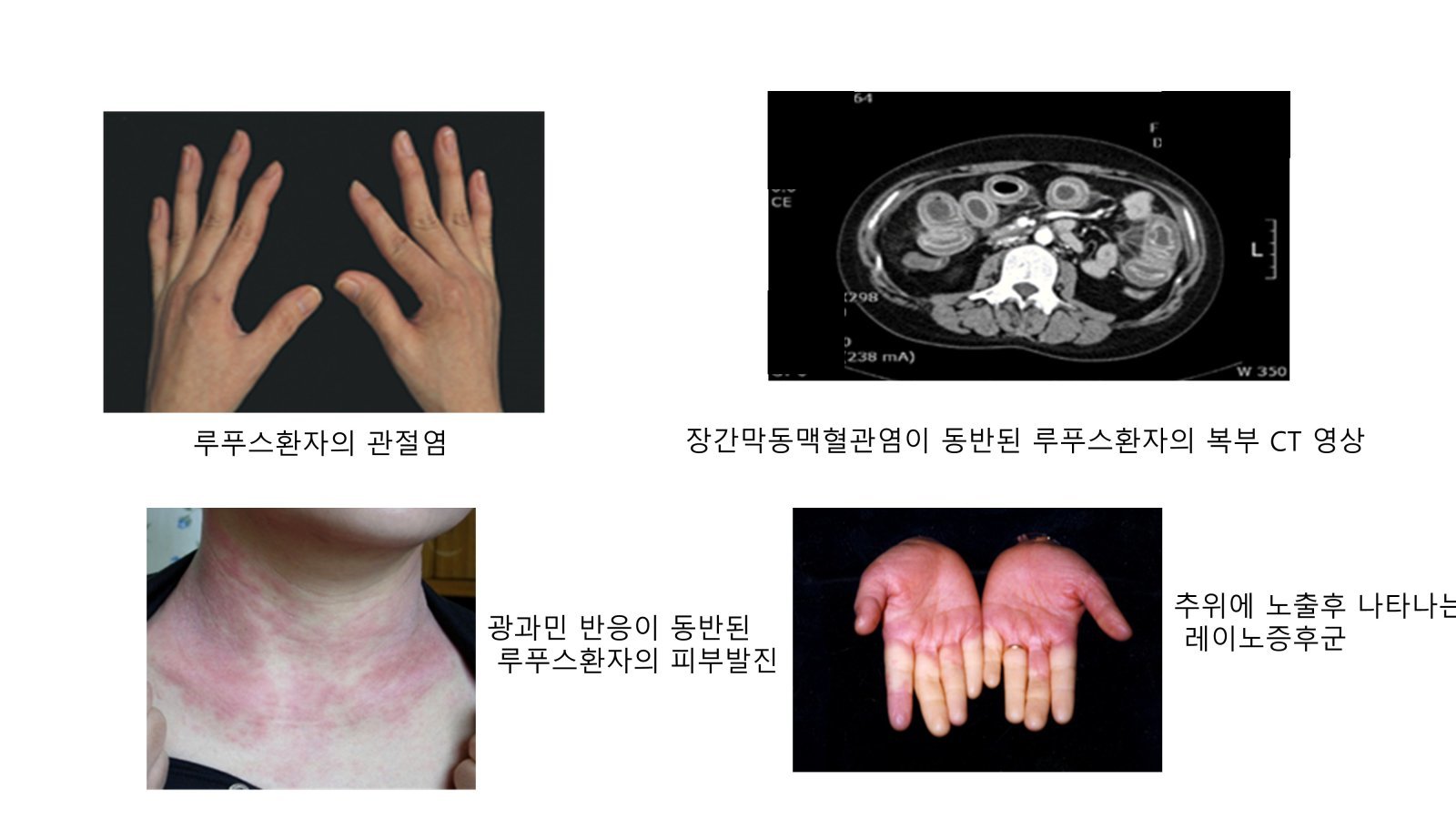 “장마철 관절이 욱신”…‘이 증상’ 겹치면 악화신호