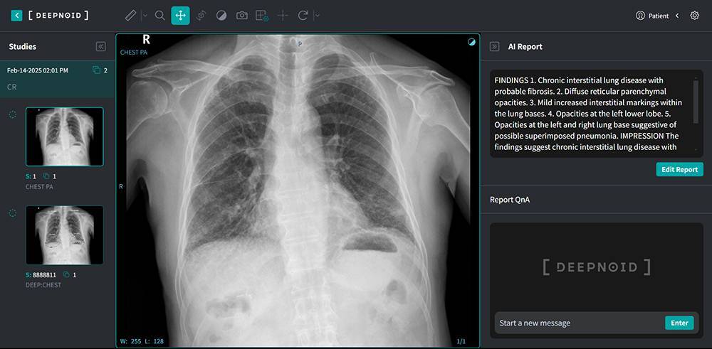 딥노이드의 흉부 엑스레이 데이터 분석 및 판독 소견서 생성 AI ‘M4CXR’, AI 판독 소견서 생성에 퓨리오사AI NPU가 도입되어 있다 / 출처=딥노이드