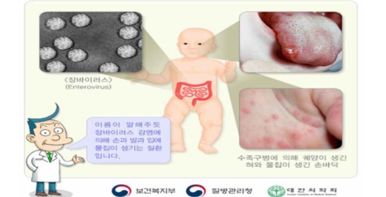 “수족구병 아이가 팔·다리까지 마비”…잇단 발생