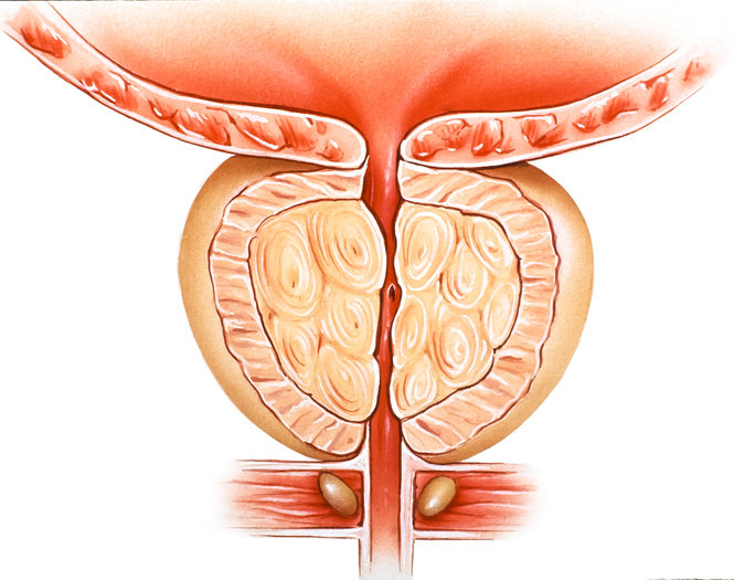 Prostate Cancer: South Korea's Top Cancer for Men; Ultra-Processed Foods Linked to Higher Risk