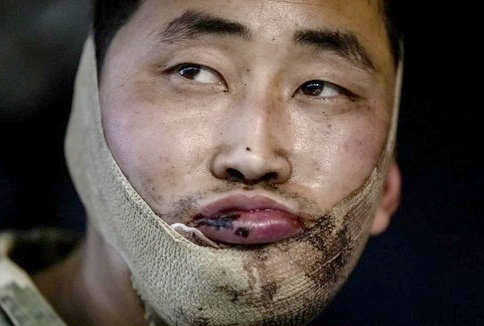 우크라이나 생포 북한군 포로의 자살 시도 증언