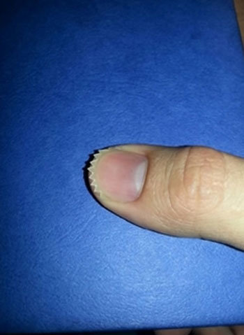 흔한 손톱 자르기