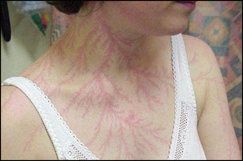 ▲ 번개가 몸에 남긴 무늬