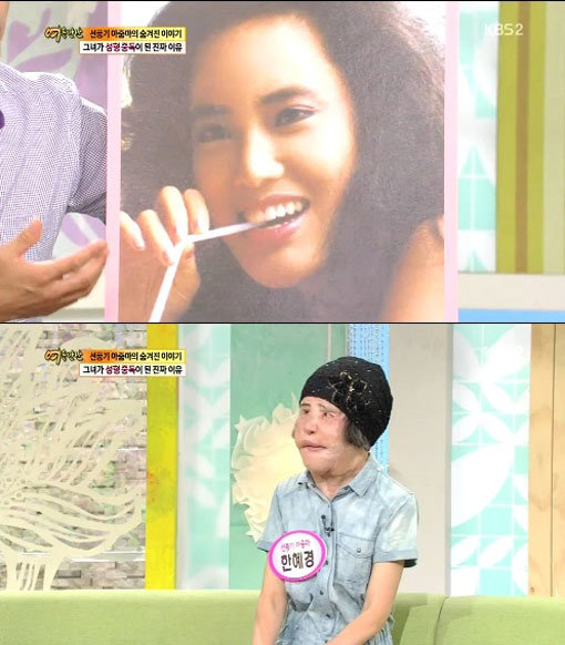 선풍기아줌마 성형 전