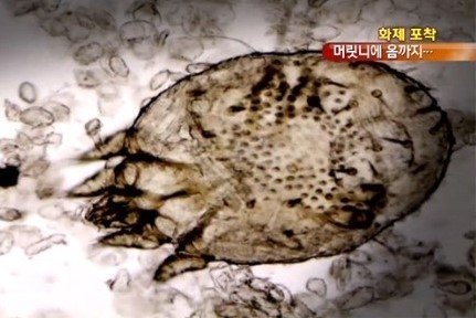 어린이 머릿니 감염 주의. 사진=KBS 방송화면 캡처.