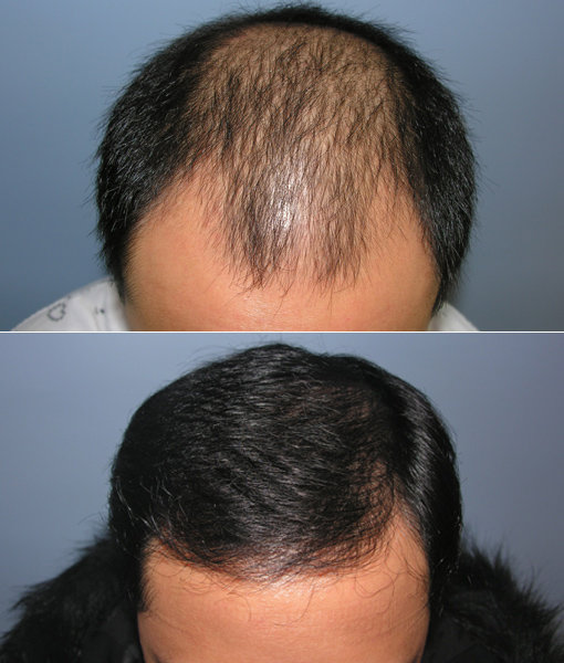 탈모는 자신감을 잃게 하는 한 요인이다. 탈모 시술 전(위)과 시술 후.