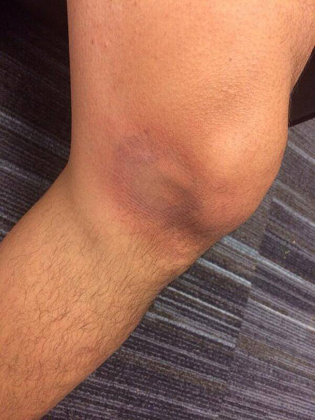 윤석민(볼티모어 트리플A 노포크 타이즈)이 22일(한국시간) 경기 도중 타구에 무릎을 맞은 부위를 직접 찍어 트위터에 올렸다. 사진출처｜윤석민 트위터