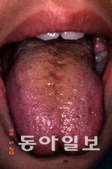 혓바늘이 생기는 원인.동아일보DB