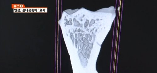 ‘평생 뼈 건강 결정’/사진= mbn 캡처