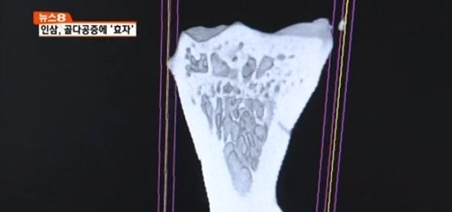 ‘평생 뼈 건강 결정’/사진= MBN 캡처