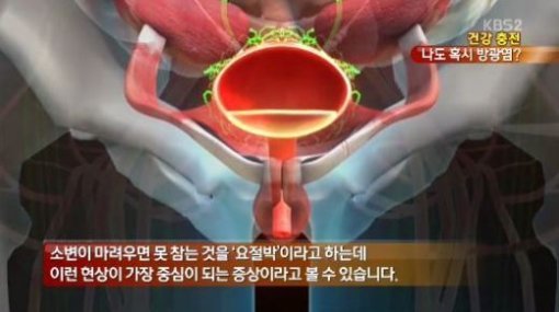 사진= KBS 영상 캡처, ‘방광염 증상’