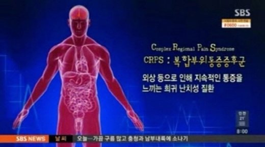 사진=복합부위 통증증후군이란. 방송화면 캡쳐