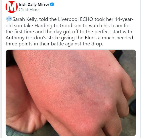 한 영국 언론이  피해 소년의 멍든 손등이라며소셜 미디어에 공개한 사진.