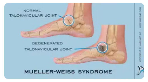 뮐러 와이즈 증후군을 설명한 자료.