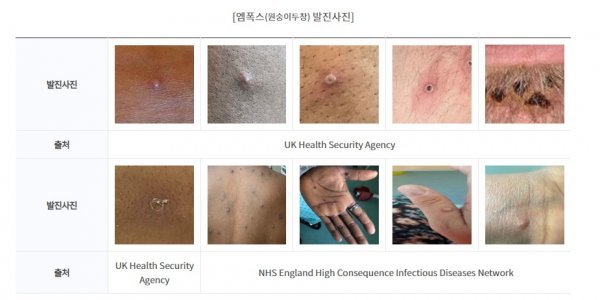 엠폭스(원숭이 두창) 발진 사진. 사진출처ㅣ질병관리청 홈페이지