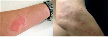 빈대에 물린 자국. 사진제공=부산시