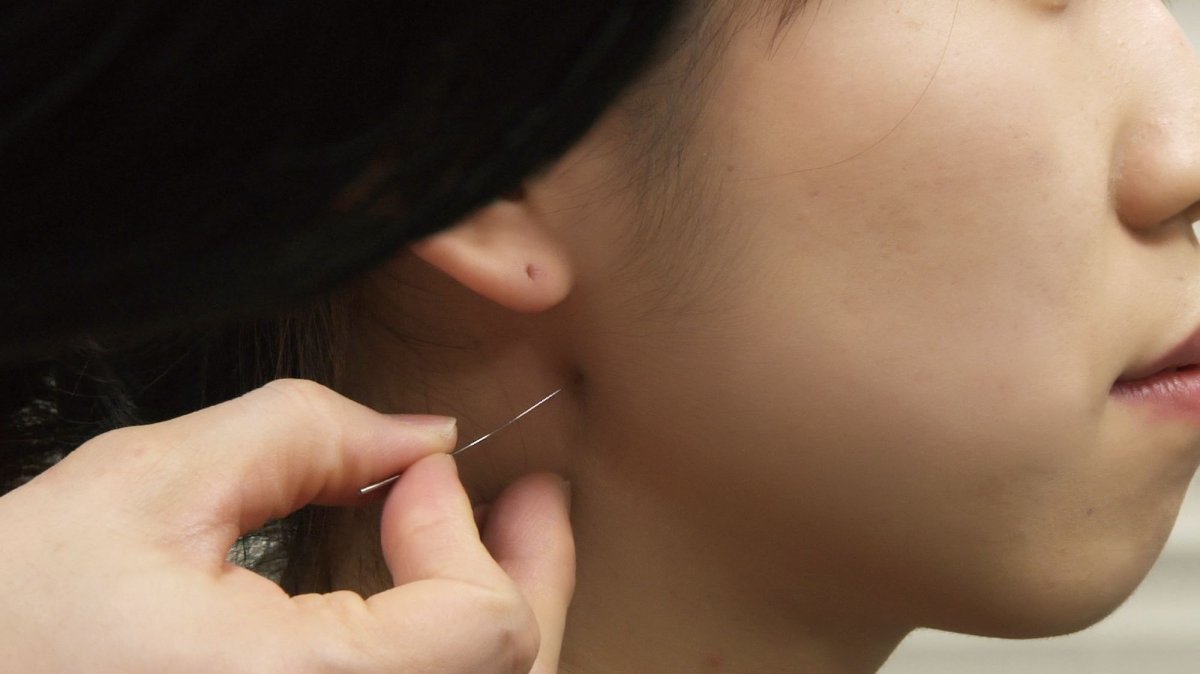 한의사가 턱관절 장애 환자에게 침치료를 시행하고 있다