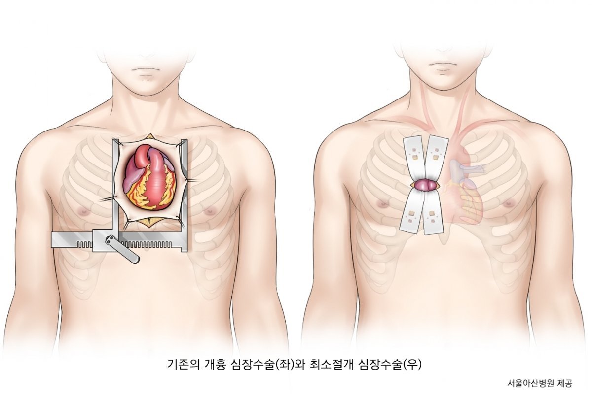 개흉심장수술과 최소절개 심장수술
인포그래픽|서울아산병원 제공