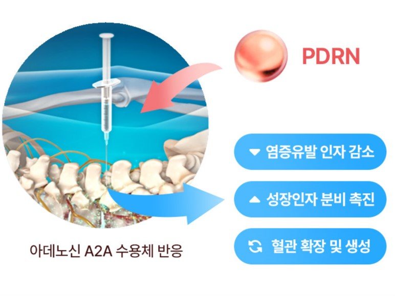 PDRN 성분 약침 치료 기전 인포그래픽|자생한방병원