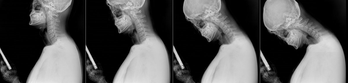 스마트폰을 이용할 때 목뼈와 척추의 모양을 찍은 X-레이. 이런 자세를 오래 하면 정상적이면 C자 모양을 해야할 목뾰가 일자목이나 거북목으로 변형되어 통증을 일으키게 된다                  사진제공｜바른세상병원