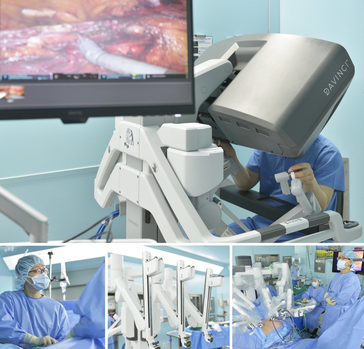 로봇탈장수술 모습           사진제공｜H+양지병원