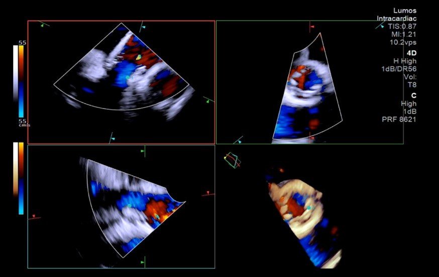 4차원(4D) 심장내 초음파(intracardiac echocardiography, ICE) 영상 이미지             사진제공 ｜중앙대광명병원