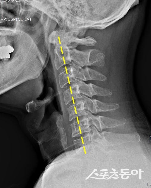 거북목 자세를 보이는 사람의 경추 X-레이. 스포츠동아DB