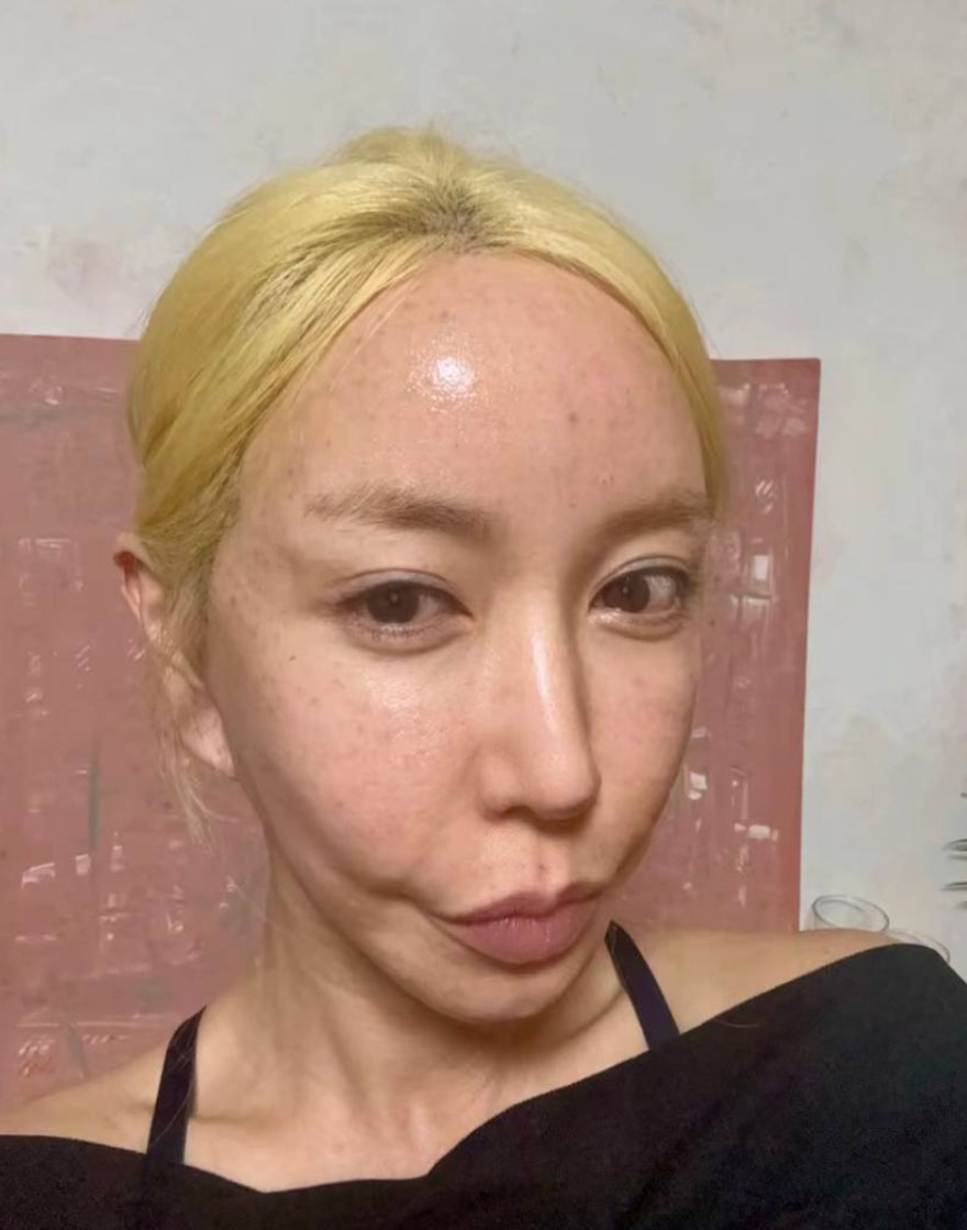 44세 S.E.S. 슈, 얼굴 가득 피딱지…적나라한 셀카 [DA★]