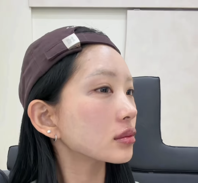 ‘故최진실 딸’ 최준희 “18살부터 입술 필러 맞았다”…시술 과정 공개