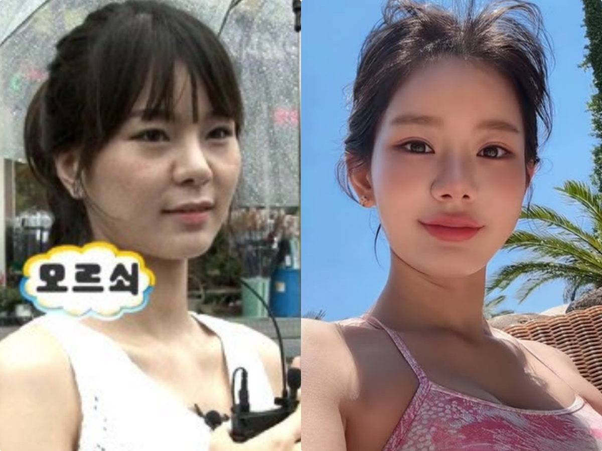 ‘무도’ 맹승지, 12년 만에 인중축소술…“실패하면 잃을 게 너무 많아” [SD톡톡]